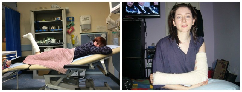 So tired - could easily have dozed off as he applied the cast! My elbow back slab from nine years ago!